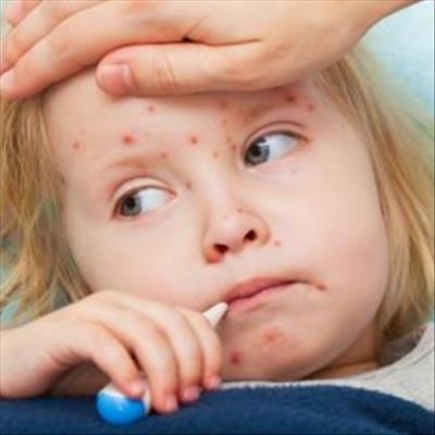 Watch out: Measles makes a comeback