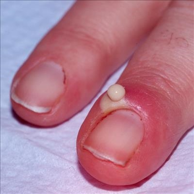 What is Paronychia?