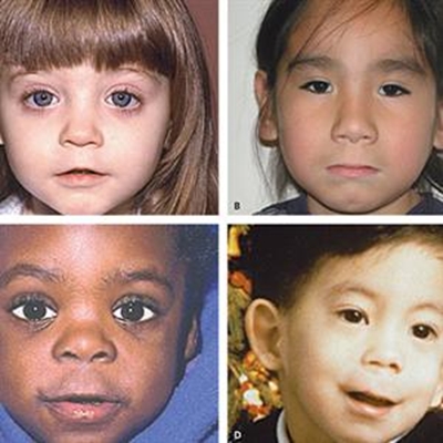 Fetal alcohol syndrome a South African pandemic