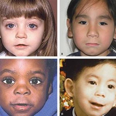 Fetal alcohol syndrome a South African pandemic