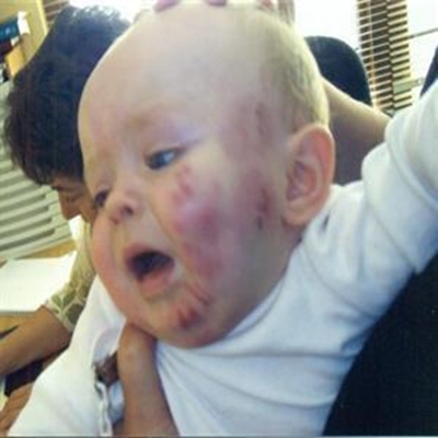 Five months on from biting incident