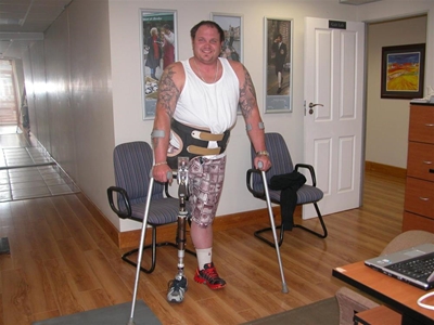 Local gets computerised prosthesis