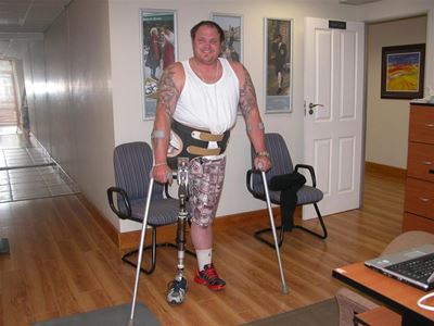 Local gets computerised prosthesis