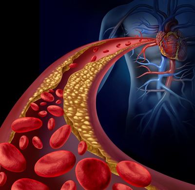 Managing your cholesterol with a healthy lifestyle