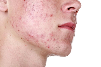 Dealing with acne