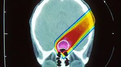 British boy gets first proton treatment in Prague