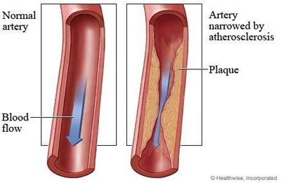 Explaining cholesterol