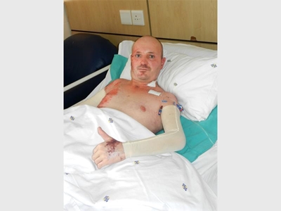 Electrician survives after third degree burns