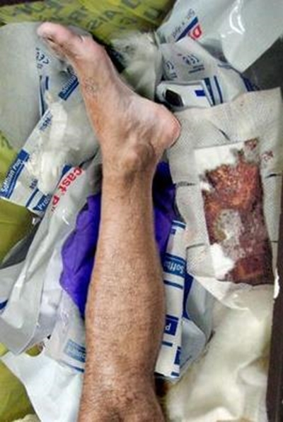Cops find man's severed leg at rubbish dump