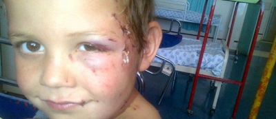 Randfontein boy, 5, attacked by dog