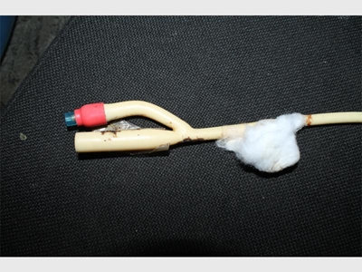 Nurses forget catheter inside man’s penis