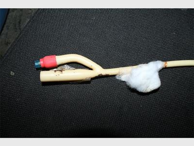 Nurses forget catheter inside man’s penis