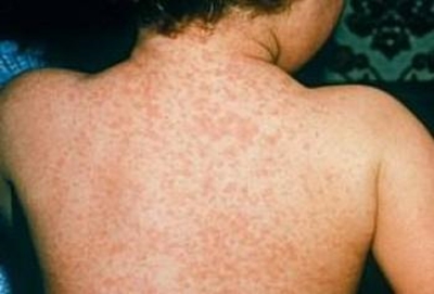 What is measles?