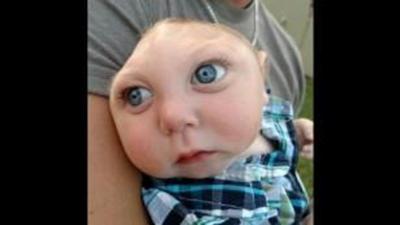 Baby born without a complete skull defies the odds
