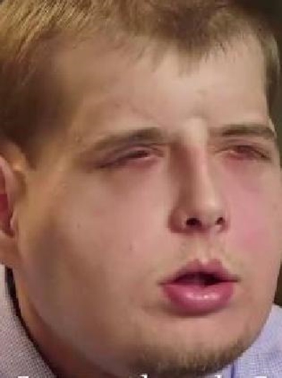 US firefighter has world's most extensive face transplant