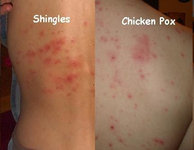 Chickenpox, shingles and postherpetic neuralgia