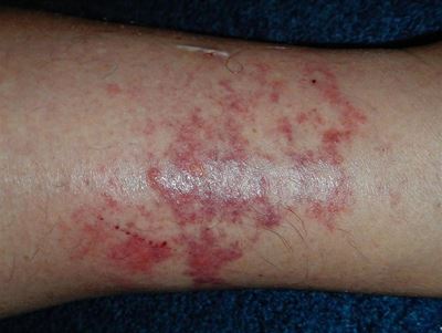 Pasop vir die sakspinnekop