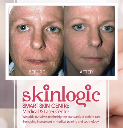 Plasma Lift @ Skinlogic: “The incredible alternative to surgery!”