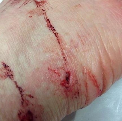 Rabid badger bites couple