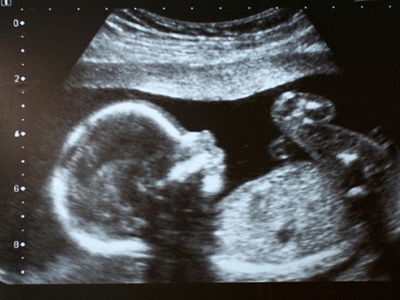 Study shows that Alzheimer’s disease could begin in womb