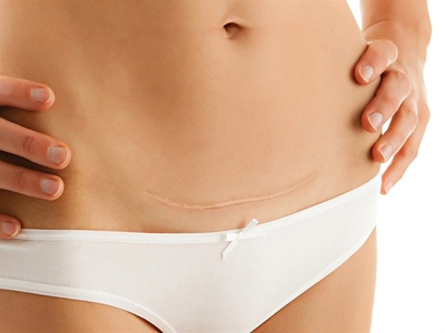 Exercising after a C-section: What you need to know