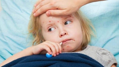 Watch out: Measles makes a comeback