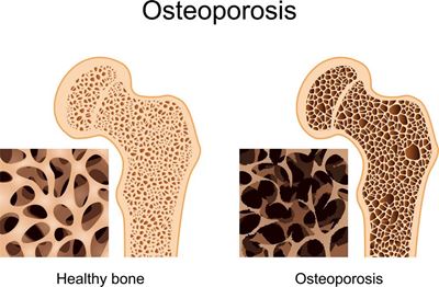 Osteoporosis and exercise