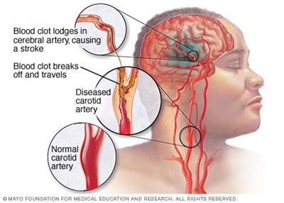Lifestyle changes could save your life