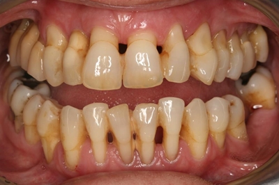 Periodontal disease