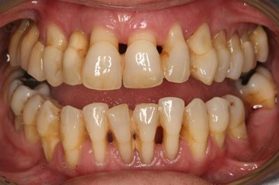 Periodontal disease