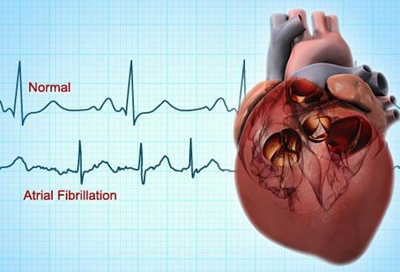 The effects of atrial fibrillation