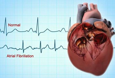 The effects of atrial fibrillation